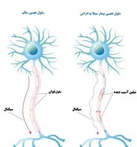 بیماری ام اس
